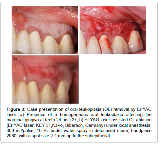 555px x 509px - Treatment Of Oral Leukoplakia By Er:YAG Laser: Current Relevance To Dental  Practice | SciTechnol