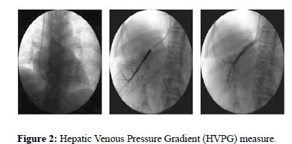 liver-transplant-measure