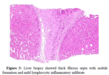 liver-transplant-septa