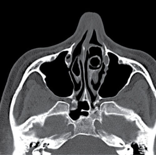 otology-rhinology-Axial-cross-section