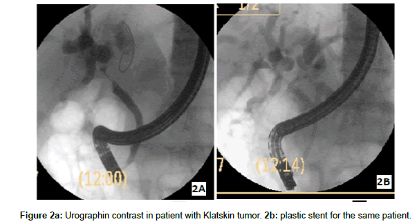 research-reports-gastroenterology-Klatskin-tumor