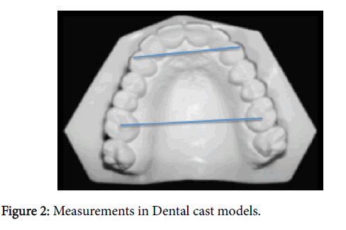 sleep-disorders-dental-cast-models