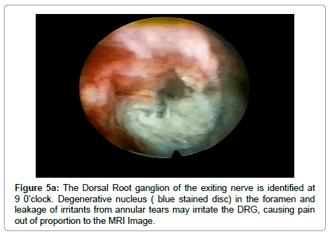 spine-neurosurgery-Dorsal-Root