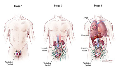 Cellular Damage to the Human Caput Epididymis Resulting from Vasal Obstruction