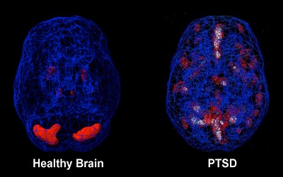 Music Therapy as a Treatment for Patients with Post-Traumatic Stress Disorder