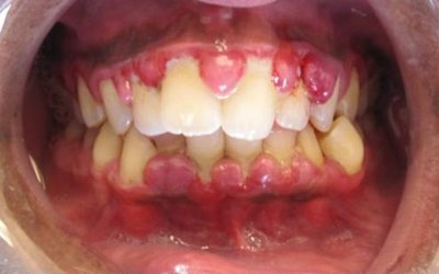 Markers of Inflammation among Nigerian Periodontitis Patients